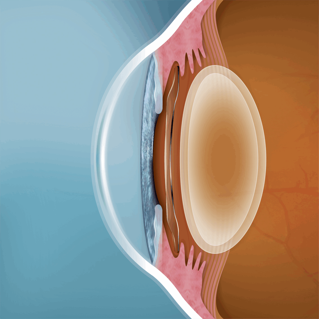 front of eye anatomy shown from the side with clear ICL lens nested between the iris and natural lens of the eye