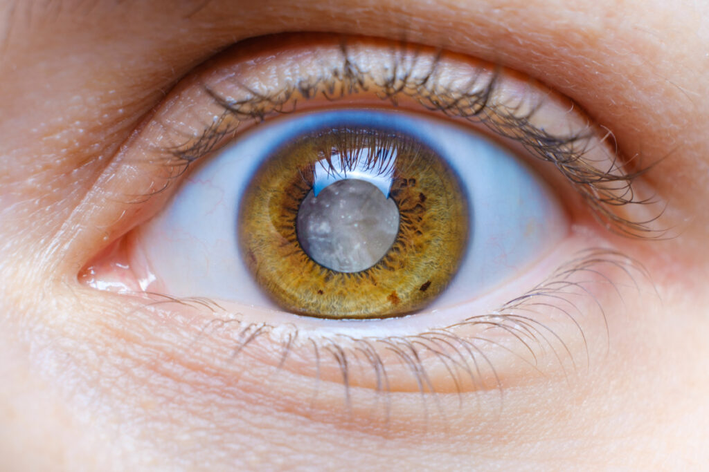 Close up of a human eye with clouded lens